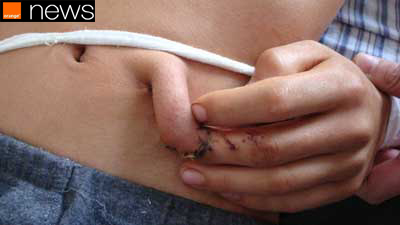 Marceneiro chinês tem seu dedo ligado à barriga para tentar reconstruir pele e músculos perdidos