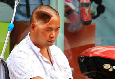 Um chinês vive com um buraco enorme na cabeça