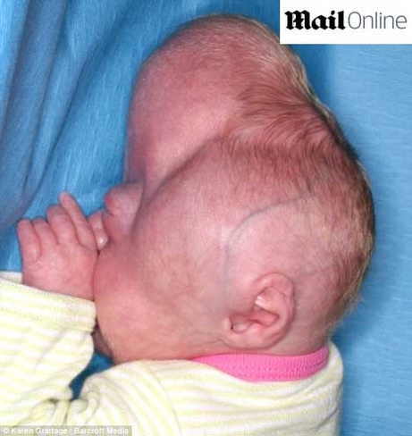 Doença rara faz bebê nascer com três crânios