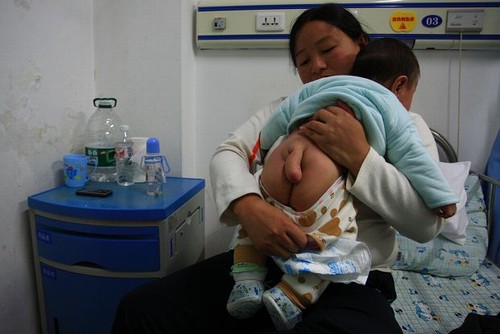 Bebê com “pênis” nas costas procura ajuda médica