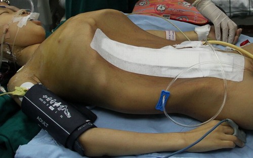 Garota de 12 anos é submetida a cirurgia para retirar tumor de 15kg