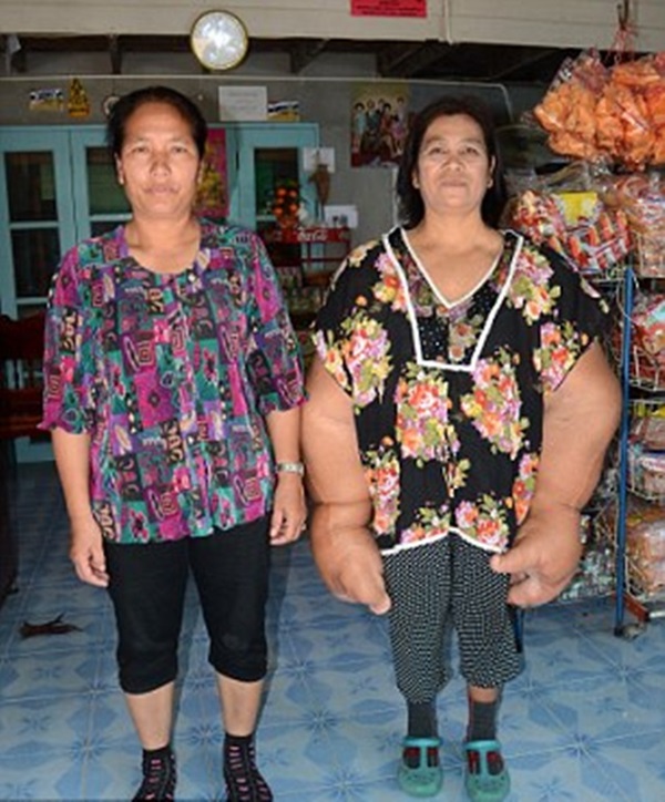 Doença rara faz com que tailandesa tenha as maiores mãos do mundo