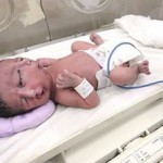 Bebê com Duas Faces Nasce no Paquistão