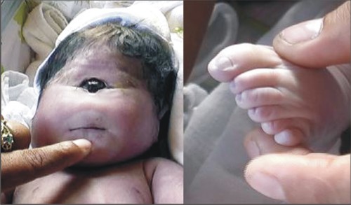 Veja uma criança que nasceu com um olho e sem nariz