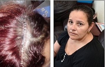 Uma mulher com cérebro repleto de larvas passou por cirurgia de emergência
