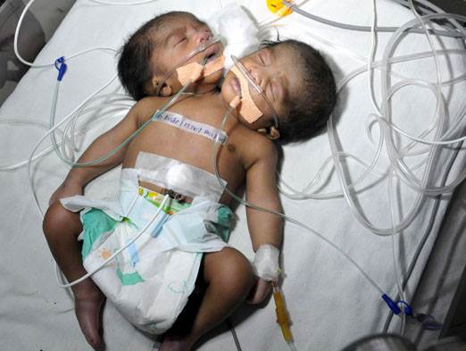 Bebê nasce com duas cabeças na Índia