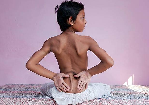 Menino de 12 anos com cauda é tratado como deus na Índia