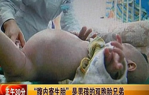 Bebê chinês “grávido” passa por cirurgia