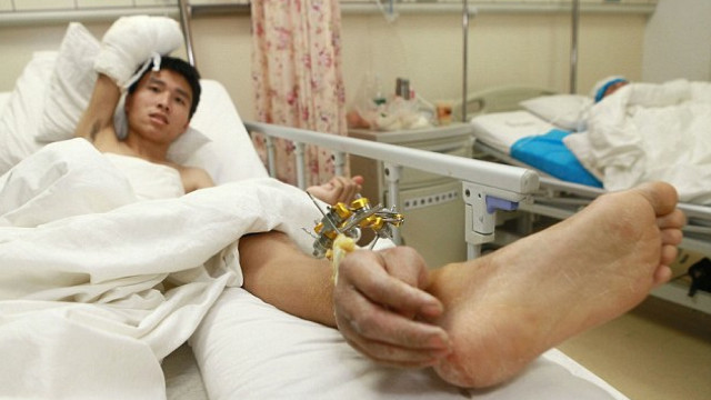 Chinês teve a mão cirurgicamente ligada ao seu tornozelo