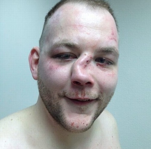 Após ser nocauteado lutador de MMA exibe nariz desfigurado