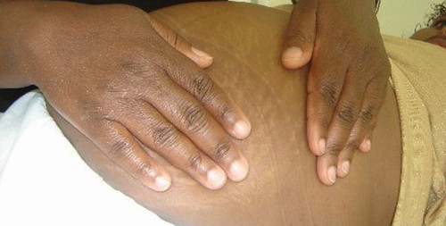 Após “gravidez” de quatro anos mulher da à luz a uma pedra