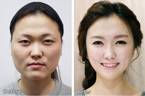 Pacientes de cirurgia plástica na Coréia do Sul ficam tão diferentes que precisam provar que são eles mesmos