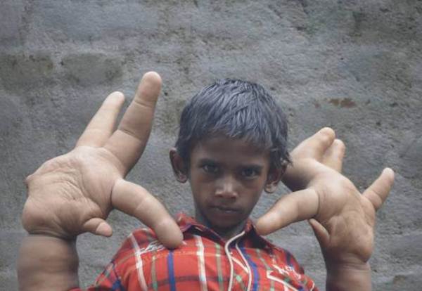 Menino indiano tem mãos gigantes de 33 centímetros e 13 quilos