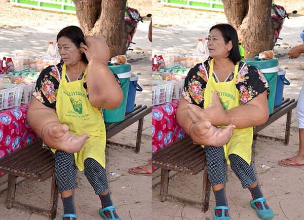 Doença rara faz com que tailandesa tenha as maiores mãos do mundo
