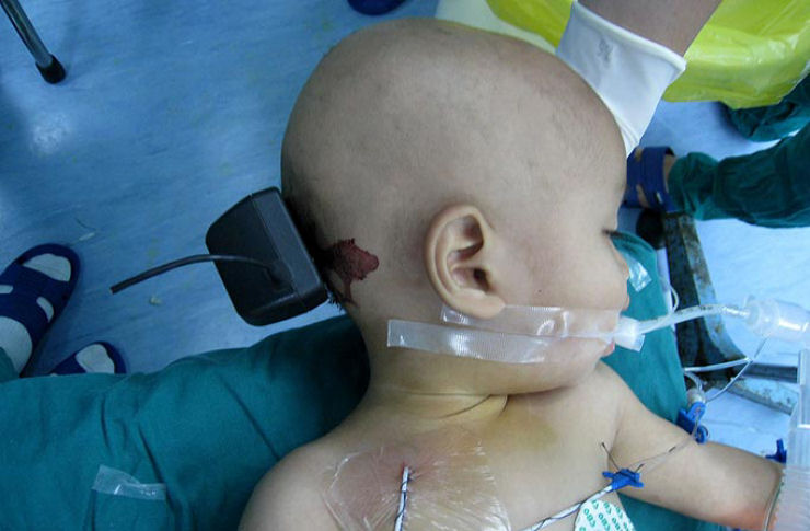 Criança de 1 ano crava carregador de celular na cabeça