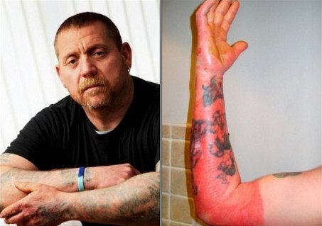 Inglês ganha “tatuagem” depois de choque elétrico