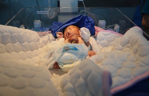Menino nasce com coração e fígado para fora do corpo na China